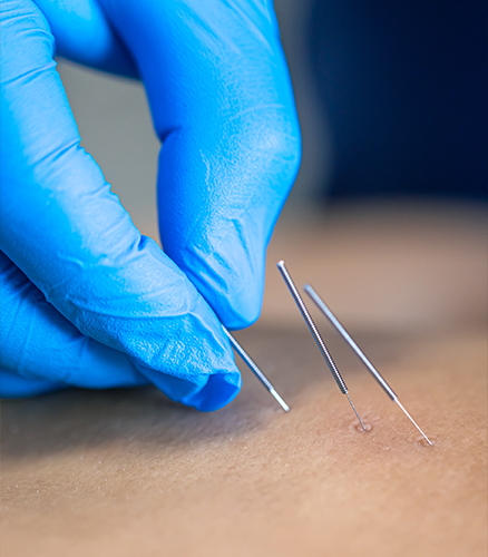 Acupuncture practitioner placing sterile needle into client’s back in clinic