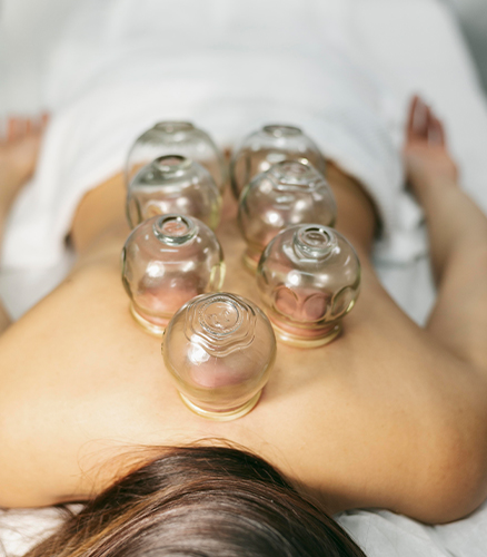 Therapist applying glass cupping cups along client’s bare upper back in treatment room