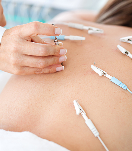 Close-up of electroacupuncture device wires connected to needles in forearm