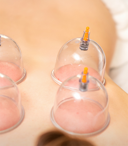 Closeup of practitioner’s hands positioning a cup on oiled skin during cupping session