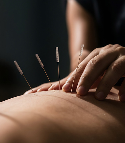 Licensed acupuncturist inserting thin needles into client’s forearm in quiet clinic